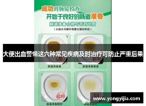 大便出血警惕这六种常见疾病及时治疗可防止严重后果